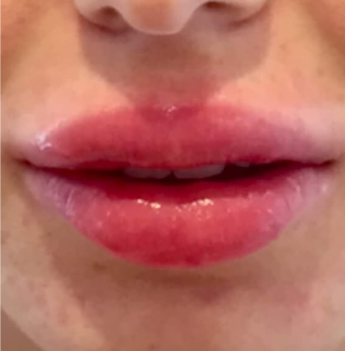 Lipofilling des lèvres - après