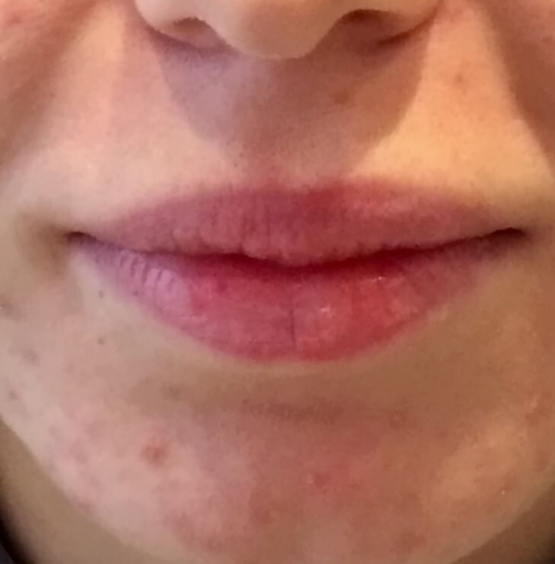 Lipofilling des lèvres - avant